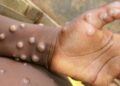 First case of MPox confirmed in Western North Region.