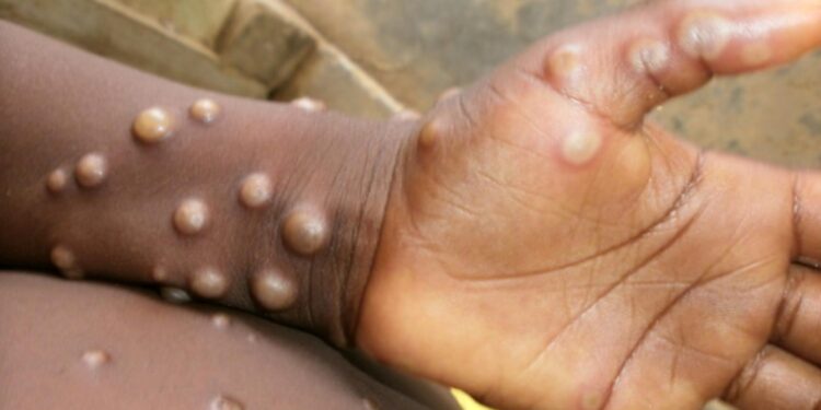First case of MPox confirmed in Western North Region.