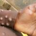 First case of MPox confirmed in Western North Region.