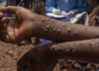 Ghana Confirms First Mpox Fatality as Cases Surge by 23, Total Now 257