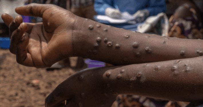 Ghana Confirms First Mpox Fatality as Cases Surge by 23, Total Now 257