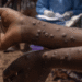 Ghana Confirms First Mpox Fatality as Cases Surge by 23, Total Now 257